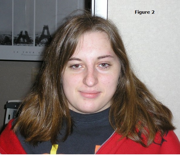 Binocular Vision Correction for the Treatment of Vestibular Symptoms